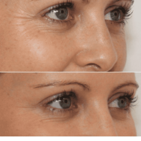 Reusable anti-wrinkle patches - 16 pieces